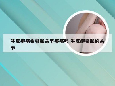 牛皮癣病会引起关节疼痛吗 牛皮癣引起的关节