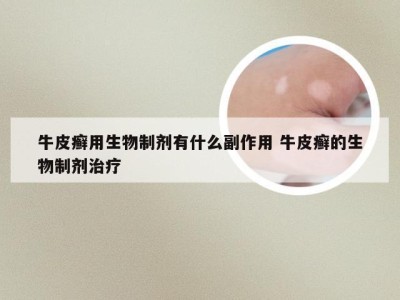 牛皮癣用生物制剂有什么副作用 牛皮癣的生物制剂治疗