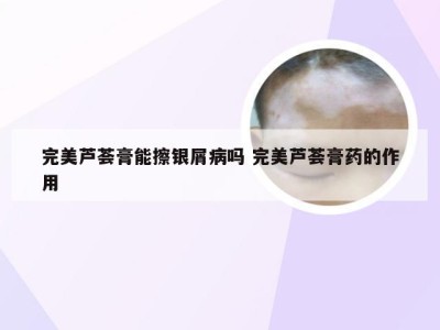 完美芦荟膏能擦银屑病吗 完美芦荟膏药的作用