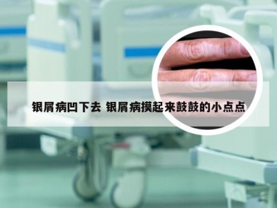 银屑病凹下去 银屑病摸起来鼓鼓的小点点