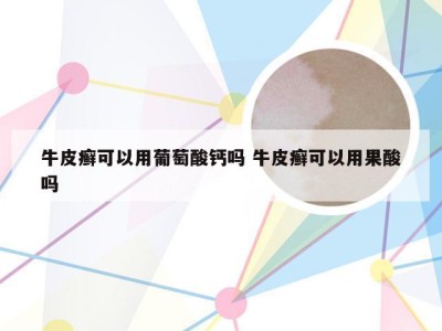 牛皮癣可以用葡萄酸钙吗 牛皮癣可以用果酸吗