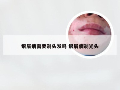 银屑病需要剃头发吗 银屑病剃光头