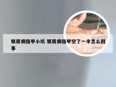 银屑病指甲小坑 银屑病指甲空了一半怎么回事
