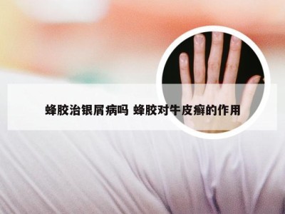 蜂胶治银屑病吗 蜂胶对牛皮癣的作用