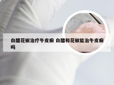 白醋花椒治疗牛皮癣 白醋和花椒能治牛皮癣吗