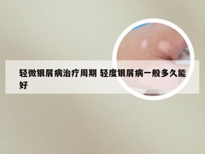 轻微银屑病治疗周期 轻度银屑病一般多久能好