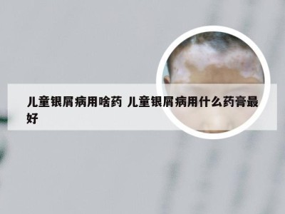 儿童银屑病用啥药 儿童银屑病用什么药膏最好