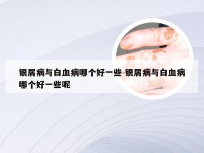 银屑病与白血病哪个好一些 银屑病与白血病哪个好一些呢