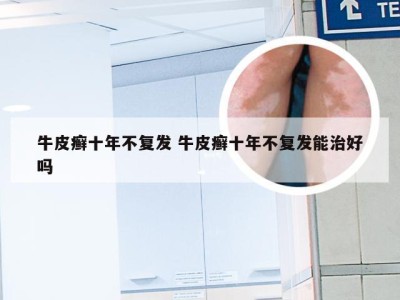 牛皮癣十年不复发 牛皮癣十年不复发能治好吗
