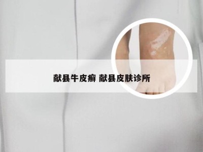 献县牛皮癣 献县皮肤诊所