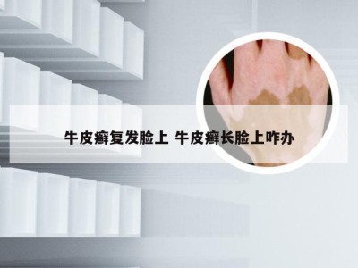 牛皮癣复发脸上 牛皮癣长脸上咋办