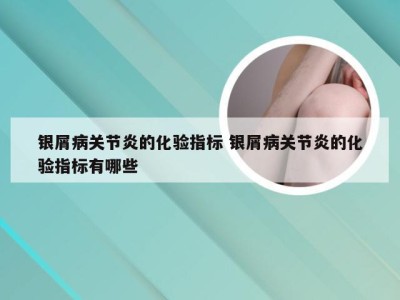 银屑病关节炎的化验指标 银屑病关节炎的化验指标有哪些