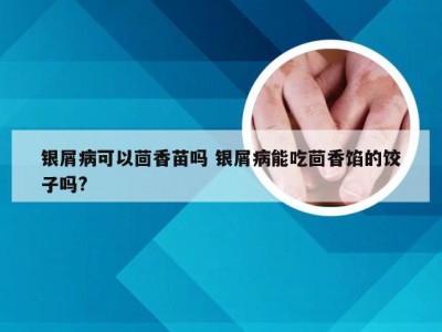 银屑病可以茴香苗吗 银屑病能吃茴香馅的饺子吗?