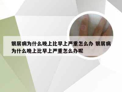 银屑病为什么晚上比早上严重怎么办 银屑病为什么晚上比早上严重怎么办呢