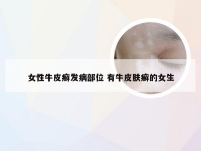 女性牛皮癣发病部位 有牛皮肤癣的女生