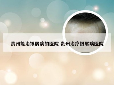 贵州能治银屑病的医院 贵州治疗银屑病医院