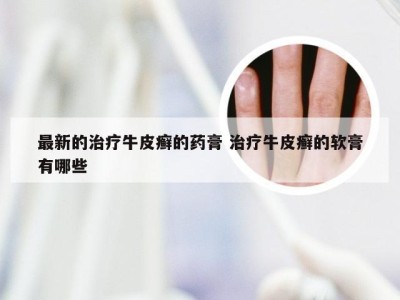 最新的治疗牛皮癣的药膏 治疗牛皮癣的软膏有哪些