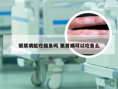 银屑病能吃鲳鱼吗 银屑病可以吃鱼么