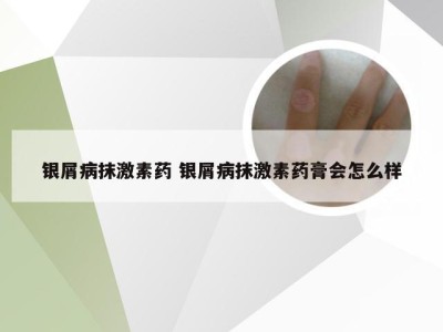 银屑病抹激素药 银屑病抹激素药膏会怎么样