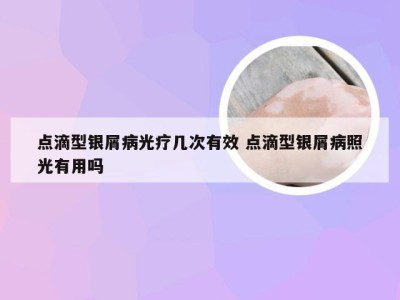 点滴型银屑病光疗几次有效 点滴型银屑病照光有用吗