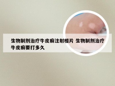 生物制剂治疗牛皮癣注射相片 生物制剂治疗牛皮癣要打多久