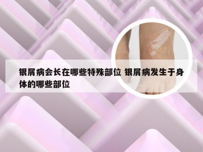 银屑病会长在哪些特殊部位 银屑病发生于身体的哪些部位