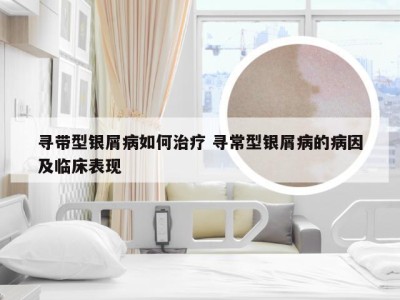 寻带型银屑病如何治疗 寻常型银屑病的病因及临床表现