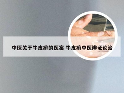 中医关于牛皮癣的医案 牛皮癣中医辨证论治