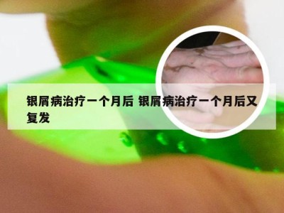 银屑病治疗一个月后 银屑病治疗一个月后又复发