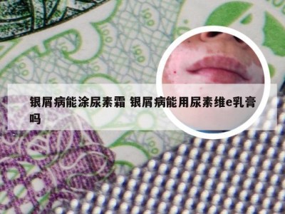 银屑病能涂尿素霜 银屑病能用尿素维e乳膏吗