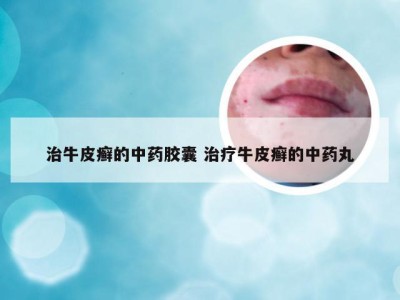 治牛皮癣的中药胶囊 治疗牛皮癣的中药丸