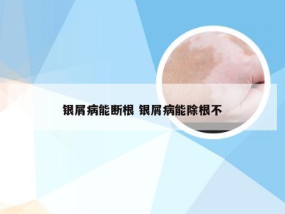 银屑病能断根 银屑病能除根不
