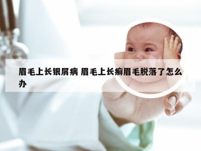 眉毛上长银屑病 眉毛上长癣眉毛脱落了怎么办
