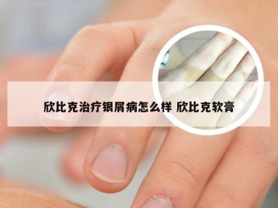 欣比克治疗银屑病怎么样 欣比克软膏