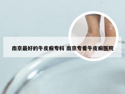 南京最好的牛皮癣专科 南京专看牛皮癣医院
