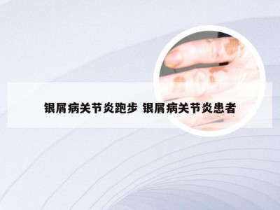 银屑病关节炎跑步 银屑病关节炎患者