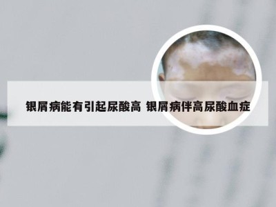 银屑病能有引起尿酸高 银屑病伴高尿酸血症