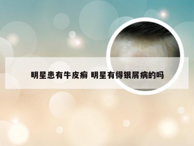 明星患有牛皮癣 明星有得银屑病的吗