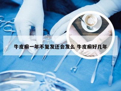 牛皮癣一年不复发还会发么 牛皮癣好几年