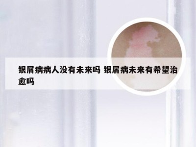 银屑病病人没有未来吗 银屑病未来有希望治愈吗