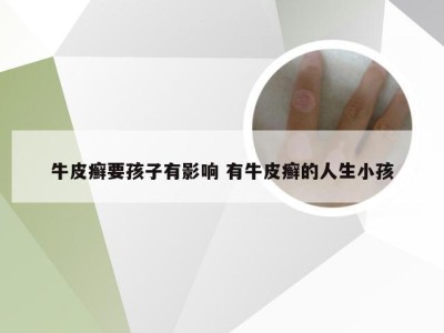 牛皮癣要孩子有影响 有牛皮癣的人生小孩