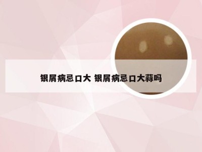 银屑病忌口大 银屑病忌口大蒜吗