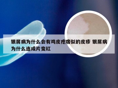 银屑病为什么会有鸡皮疙瘩似的皮疹 银屑病为什么连成片变红