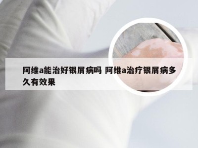 阿维a能治好银屑病吗 阿维a治疗银屑病多久有效果
