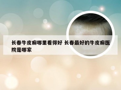 长春牛皮癣哪里看得好 长春最好的牛皮癣医院是哪家