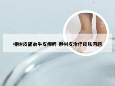 柳树皮能冶牛皮癣吗 柳树皮治疗皮肤问题