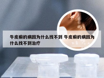 牛皮癣的病因为什么找不到 牛皮癣的病因为什么找不到治疗