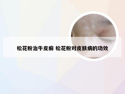 松花粉治牛皮癣 松花粉对皮肤病的功效