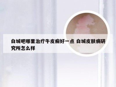 白城吧哪里治疗牛皮癣好一点 白城皮肤病研究所怎么样
