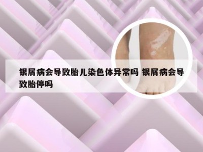 银屑病会导致胎儿染色体异常吗 银屑病会导致胎停吗